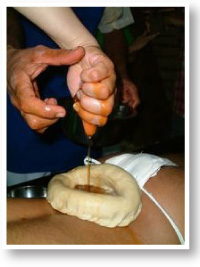 インド伝統医療